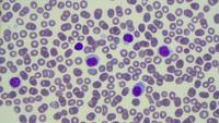 Hairy cell leukemia