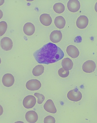 T Lgl Leukemia Peripheral Smear Figure 2