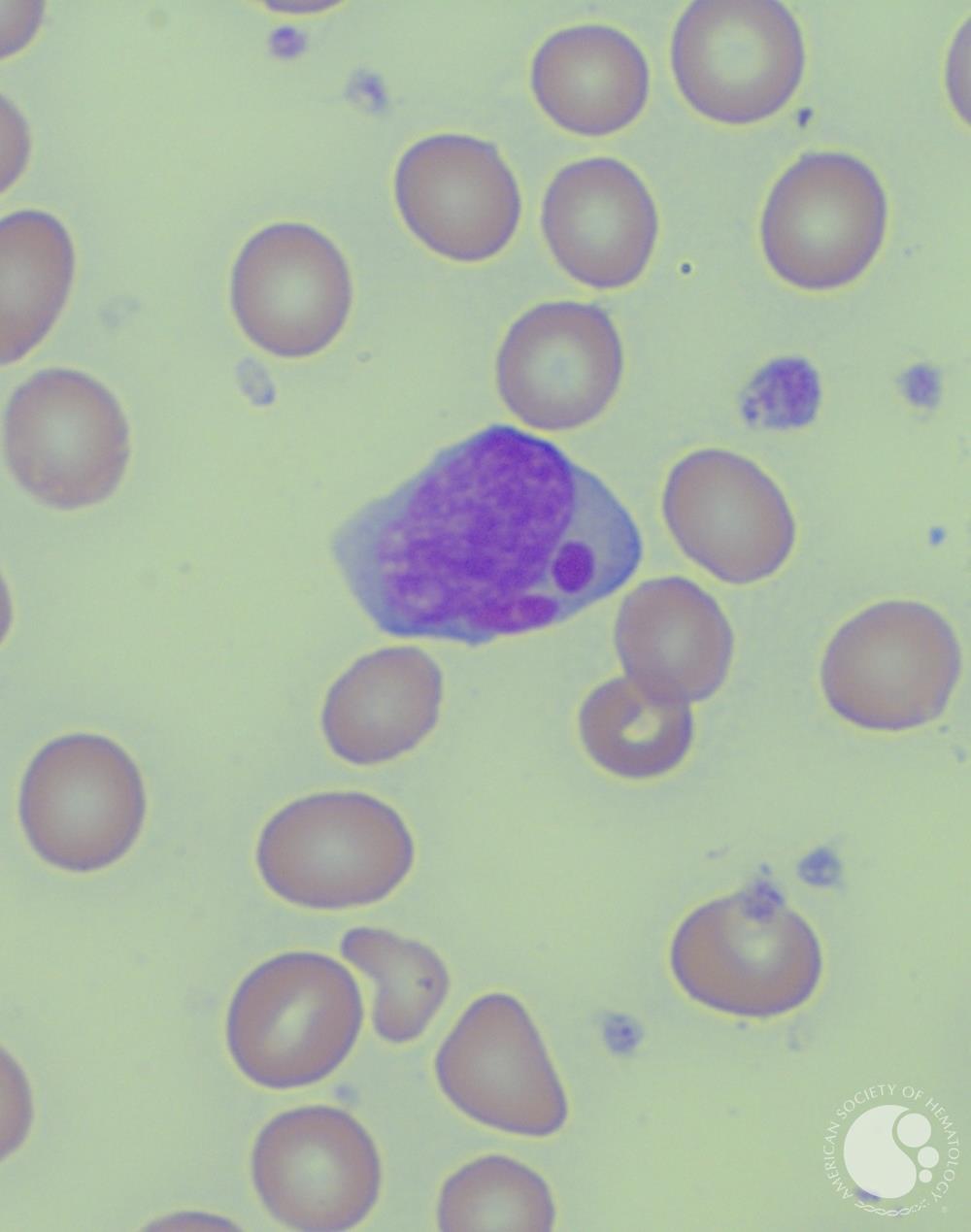 T-LGL leukemia - Peripheral smear - Figure 2