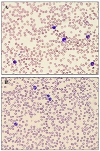 Mechanical hemolytic anemia (40x).