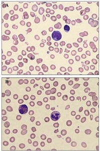 Mechanical hemolytic anemia (100x).