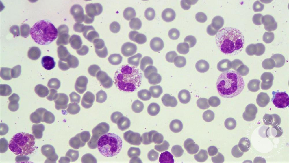 Chronic eosinophilic leukemia with FIP1L1-PDGFRA