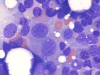 AML with myelodysplasia related changes- Bone marrow aspirate