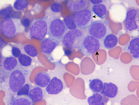AML-with-myelodysplasia-related-changes-Bone-marrow-aspirate