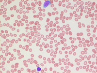 AML with myelodysplasia related changes- Peripheral blood smear