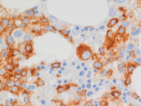 AML with myelodysplasia related changes-Bone marrow biopsy- CD34