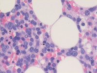 AML with myelodysplasia related changes- Bone marrow biopsy H&E