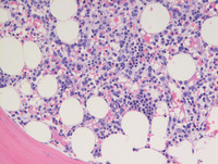 AML with myelodysplasia related changes- Bone marrow biopsy H&E