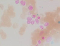 AML with myelodysplasia related changes- Bone marrow biopsy Iron