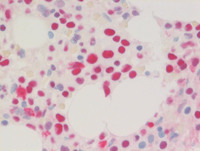 AML with myelodysplasia related changes- Bone marrow biopsy NPM1