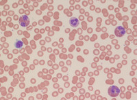 Lymphocytic variant of HES- Peripheral blood