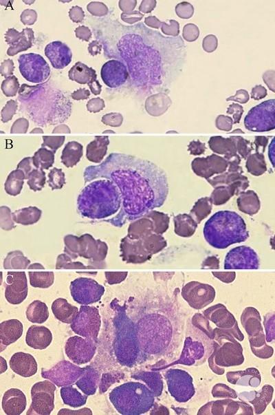 Different phases of hemophagocytosis in bone marrow (100x).