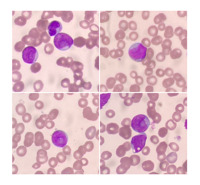 Cup-like or fish mouth blasts in AML