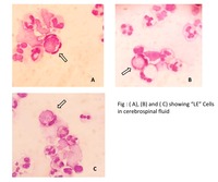 LE cells in Cerebrospinal Fluid