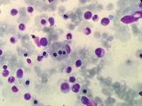 Hemophagocytic lymphohistiocytosis (HLH): a deadly masquerader