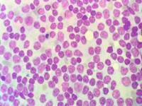 Chronic lymphocytic leukemia:  Nuclei with ''Soccer ball chromatin''