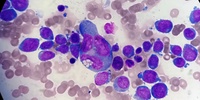 Tumour giant cell in acute leukaemia