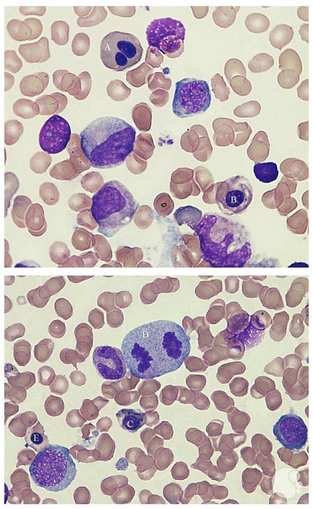 Megaloblastic anemia (100x). 2