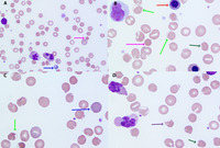 Peripheral Blood Smear Findings In Covid Coagulopathy