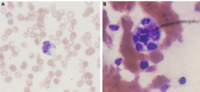 Peripheral Blood Hemophagocytosis as a Rare a Clue to Hemophagocytic Lymphohistiocytosis