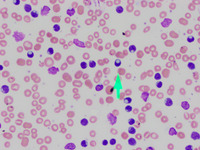 Cytoplasmic inclusions in CLL lymphocytes 2