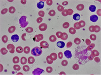 Cytoplasmic Inclusions In Cll Lymphocytes 3