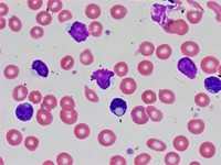 Cytoplasmic inclusions in CLL lymphocytes 4