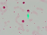 Cytoplasmic inclusions in CLL lymphocytes (Mucicarmine)