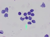 Cytoplasmic inclusions in CLL lymphocytes (PAS)