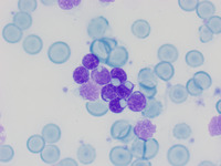 Cytoplasmic Inclusions In Cll Lymphocytes Toluidine Blue
