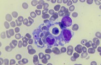 Hemophagocytosis