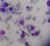 L D Bodies in bone marrow aspirate smear