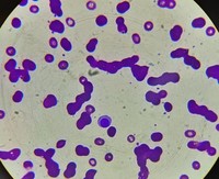 Rouleaux formation in Myeloma