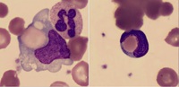 ERTHYROPHAGOCYTOSIS