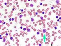 CLL lymphocytes with cytoplasmic inclusions 1