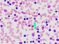 CLL lymphocytes with cytoplasmic inclusions 2