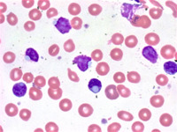 CLL lymphocytes with cytoplasmic inclusions 4