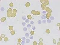 CLL lymphocytes with cytoplasmic inclusions (oil red O)