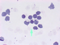 CLL lymphocytes with cytoplasmic inclusions (PAS)
