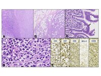 Monomorphic Epitheliotropic Intestinal T-cell Lymphoma