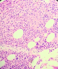 acute lymphoblastic leukemia bone marrow biopsy