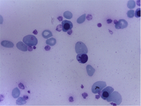 G-6-PD deficiency & eryptosis vs dyserythropoesis