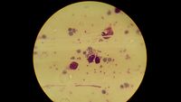 Leishman body In Leishmaniasis