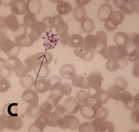 Plasmodium vivax  amoeboid and schizont forms in PBS 1