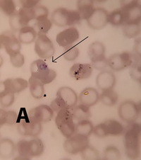 Plasmodium vivax  amoeboid and schizont forms in PBS 2