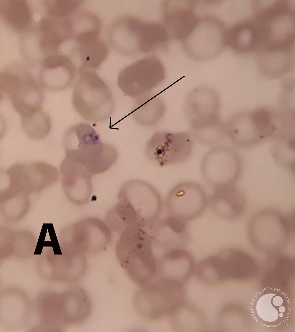 Plasmodium vivax  amoeboid and schizont forms in PBS 2