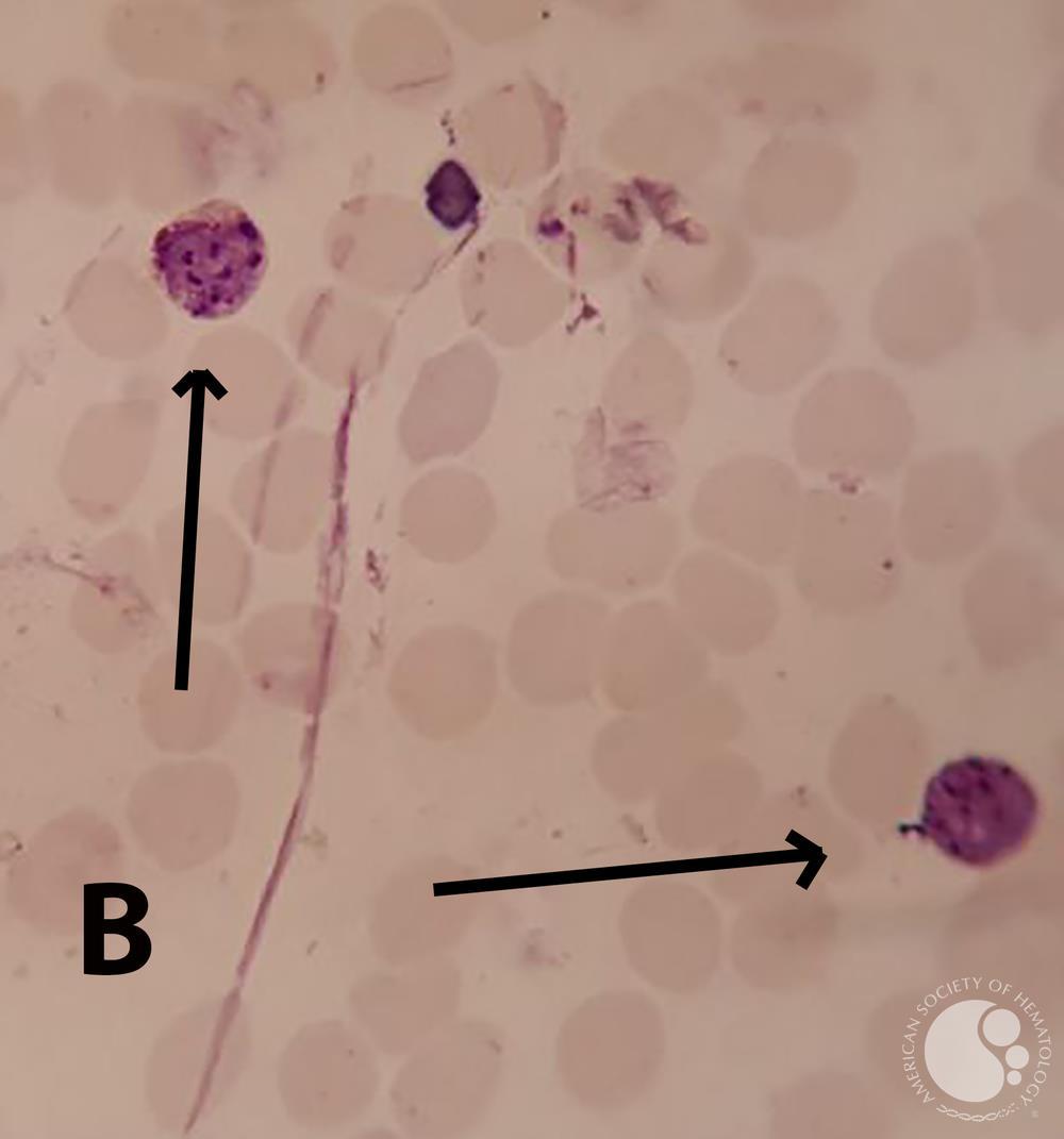 Plasmodium vivax  amoeboid and schizont forms in PBS 3