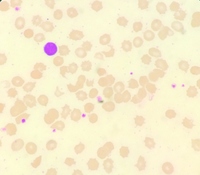 ACANTHOCYTES IN PERIPHERAL BLOOD SMEAR 1