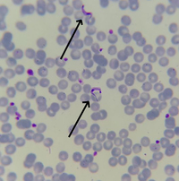 Human African trypanosomiasis diagnosis by peripheral blood smear ...