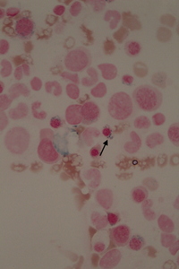 Iron distribution patterns of ACD and MDS